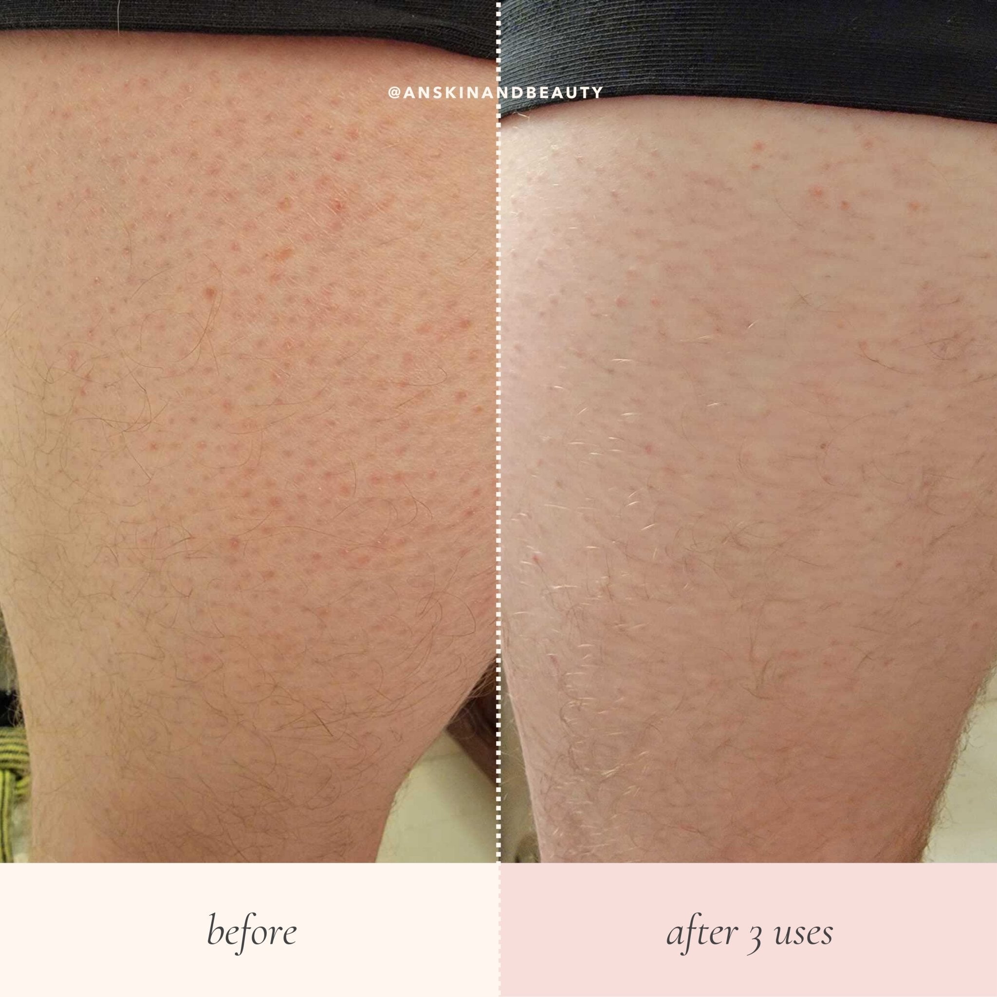 What You Should Know About Keratosis Pilaris – AN Skin & Beauty What You Should Know About Keratosis Pilaris – AN Skin & Beauty