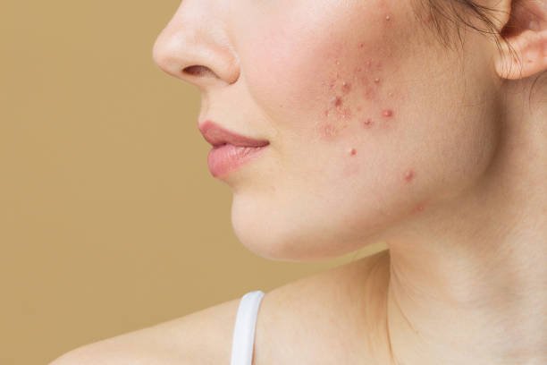 How To Clear Your Period Acne For Good - AN Skin & Beauty