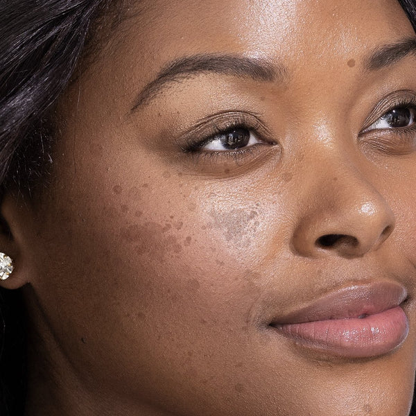 Radiant Solutions For Hyperpigmentation - AN Skin & Beauty
