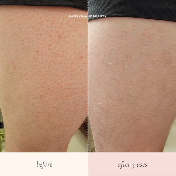 What You Should Know About Keratosis Pilaris - AN Skin & Beauty